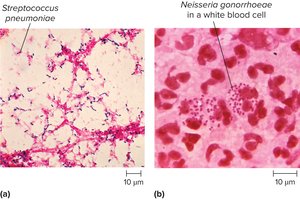 Gram stain of Streptococcus pneumoniae and Neisseria gonorrhoeae