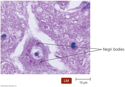 Negri bodies in rabies infection