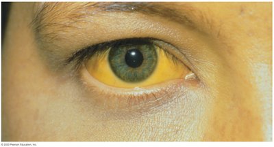 Jaundice in hepatitis B infection