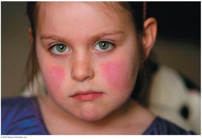 Fifth disease (erythema infectiosum) rash on cheeks
