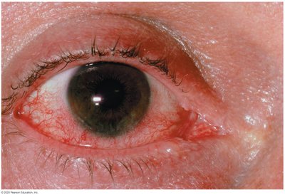 Adenoviral conjunctivitis (pinkeye)