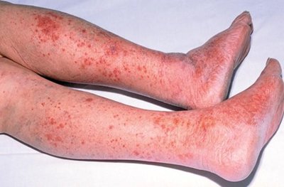 Petechial rash on legs due to meningococcal infection