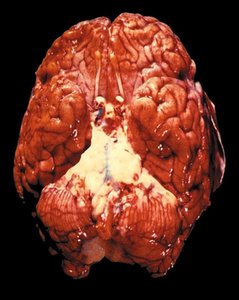 Brain with purulent exudate from pneumococcal meningitis