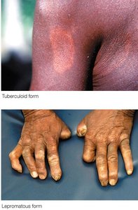 Tuberculoid and lepromatous forms of leprosy
