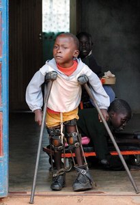 Child with polio using crutches and leg braces