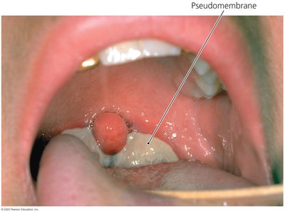 Pseudomembrane in diphtheria patient