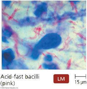Acid-fast bacilli (pink) under light microscopy
