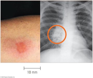 Tuberculin skin test and chest X-ray for TB diagnosis