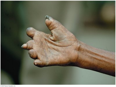 Hand deformity in lepromatous leprosy