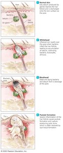 Stages of acne development