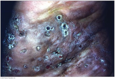 Cutaneous lesions caused by Nocardia infection
