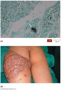Actinomycosis: histological and clinical presentation