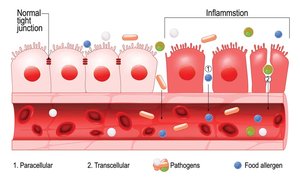 Diagram of normal vs. inflamed gut lining showing increased permeability