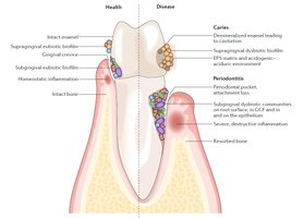Comparison of healthy and diseased tooth surfaces