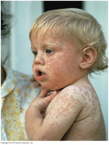 Child with measles rash
