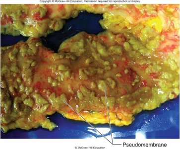 Pseudomembrane formation in C. difficile infection