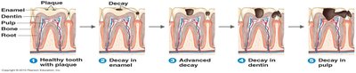 Progression of tooth decay from plaque to pulp