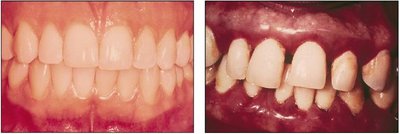 Healthy vs. diseased gums