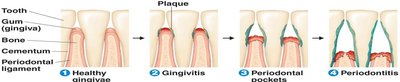 Stages of periodontal disease