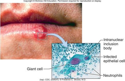 Oral herpes simplex lesion and infected cells