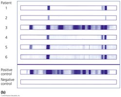 Immunoblotting results for multiple patients