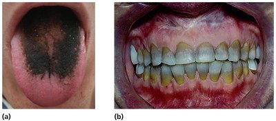 Side effects of antimicrobial agents: black hairy tongue and tooth discoloration