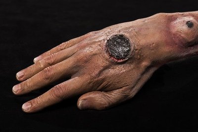 Cutaneous anthrax lesion on hand