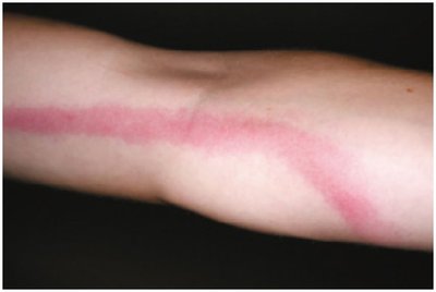 Lymphangitis: inflamed lymph vessel visible as a red streak