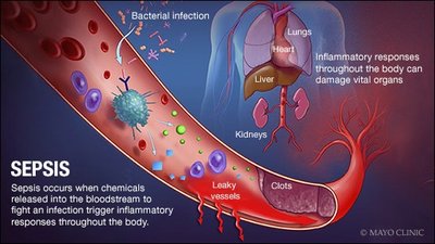 Diagram explaining sepsis and its effects on the body