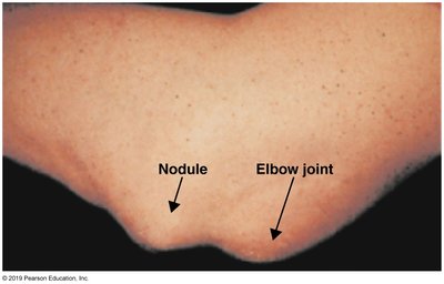 Nodule at elbow joint in rheumatic fever