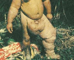 Filarial elephantiasis caused by adult worms