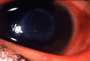 Acanthamoeba keratitis: white patches on cornea