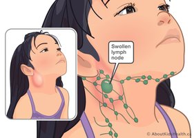 Swollen lymph node clinical diagram