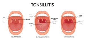 Tonsil immune surveillance diagram