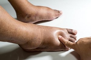 Edema due to excess interstitial fluid