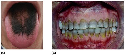 Side effects of antimicrobial agents: black hairy tongue and tooth discoloration