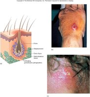 Sectional view of a boil (furuncle)