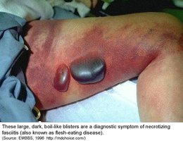 Necrotizing fasciitis (flesh-eating disease)