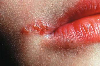 Latent infection flare-up example