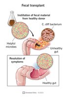 Fecal microbiota transplant procedure