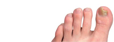 Tinea unguium (onychomycosis)