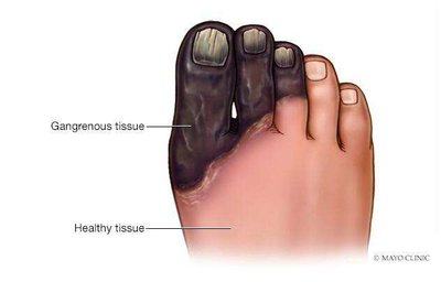 Gangrenous tissue caused by Clostridium perfringens