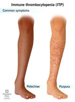 Symptoms of Immune Thrombocytopenia (ITP): Petechiae and Purpura
