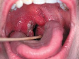 Clinical image of pharyngitis with exudate