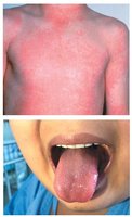 Scarlet fever rash and strawberry tongue