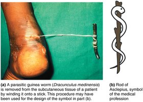 Guinea worm removal