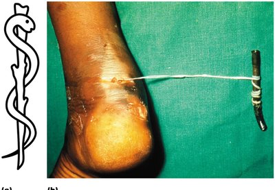 Parasitic guinea worm removal and Rod of Asclepius