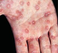 Secondary syphilis: rash on hand