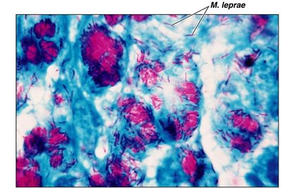 Gram stain results: purple and red cells