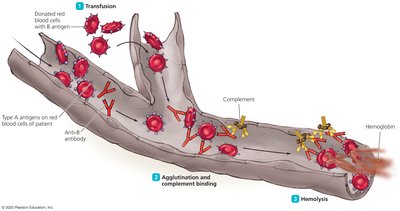 Diagram of transfusion reaction and hemolysis